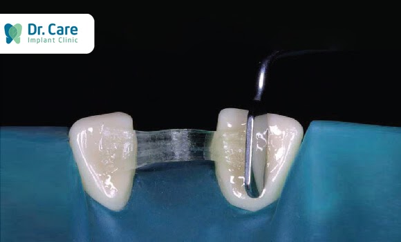 các loại cầu răng sứ, Cầu răng sứ Composite  