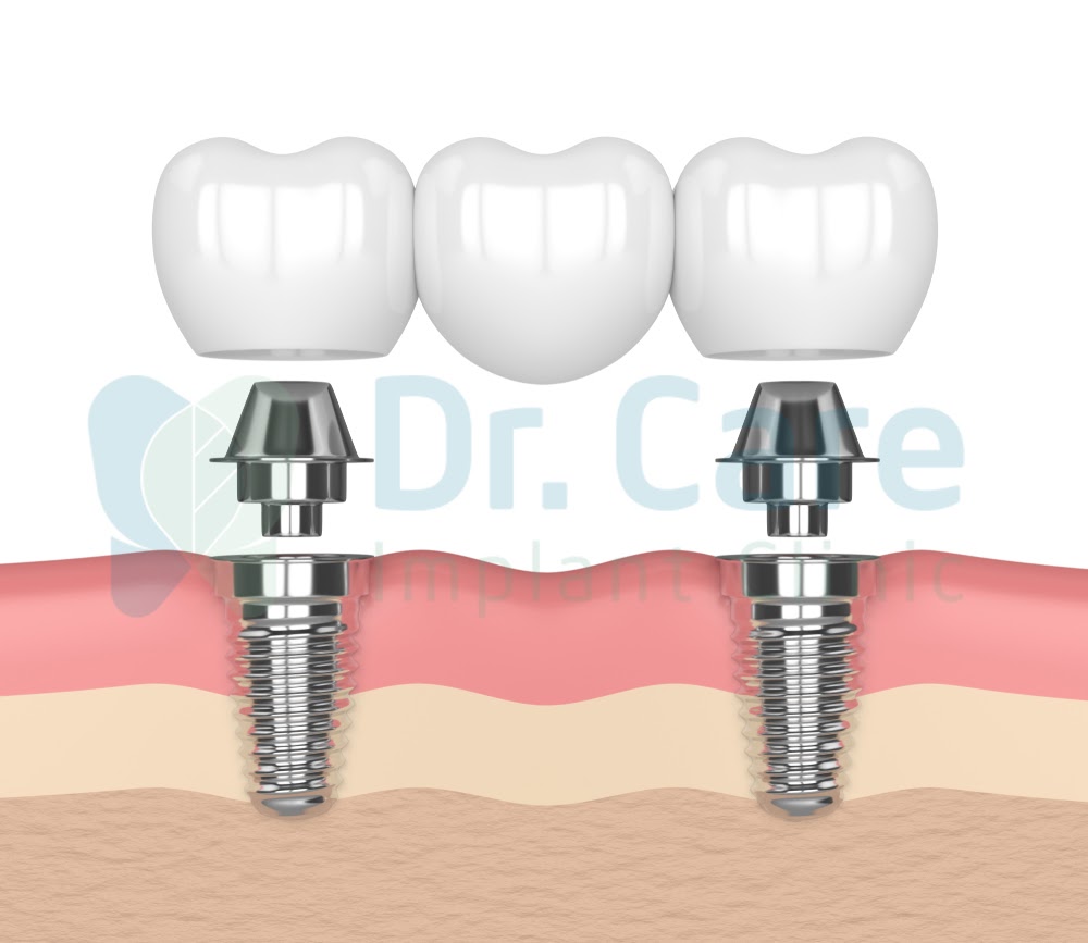các loại cầu răng sứ, cầu răng sứ với implant hỗ trợ