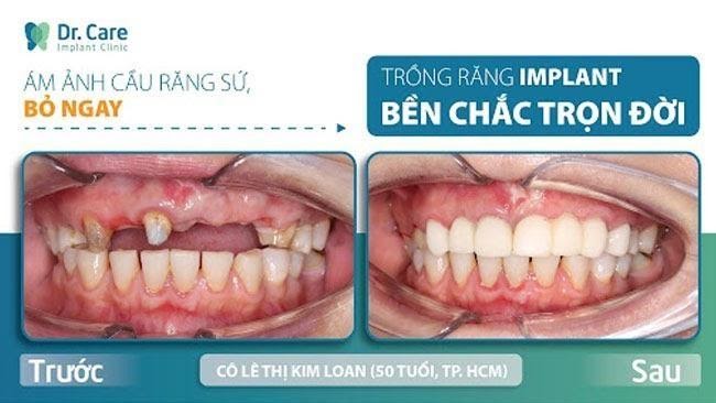 Mất răng do bọc răng sứ sai kỹ thuật làm sao khắc phục?