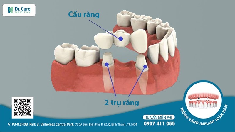 đặc điểm của phương pháp làm cầu răng sứ