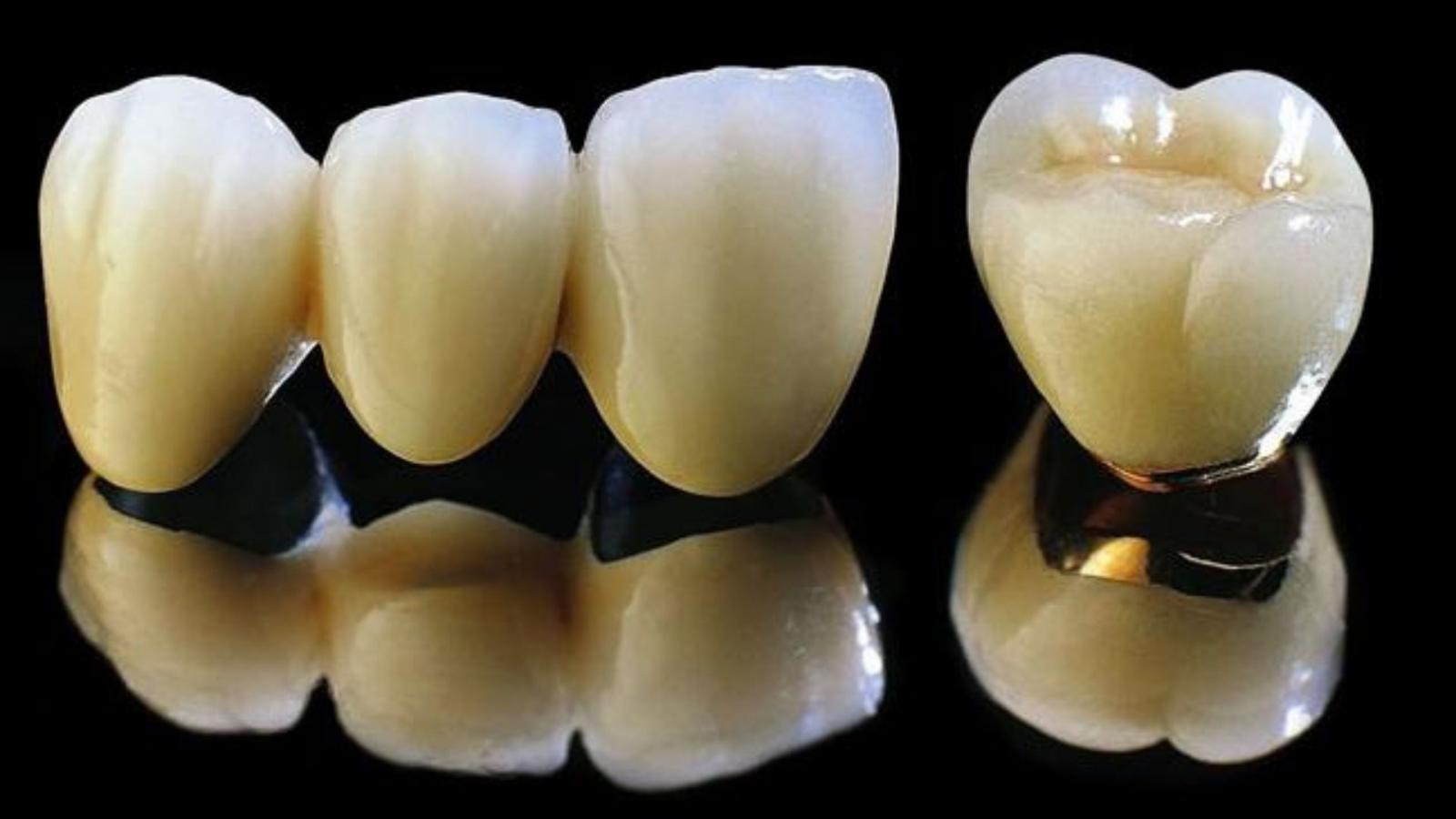 Các loại răng sứ thường được sử dụng