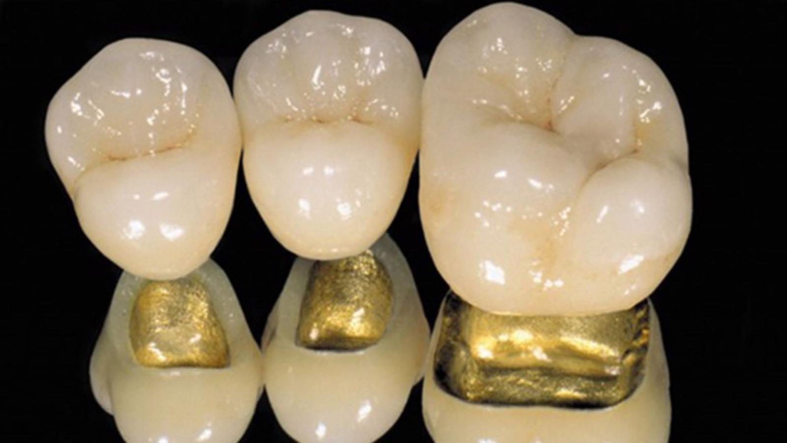 Các loại răng sứ thường được sử dụng