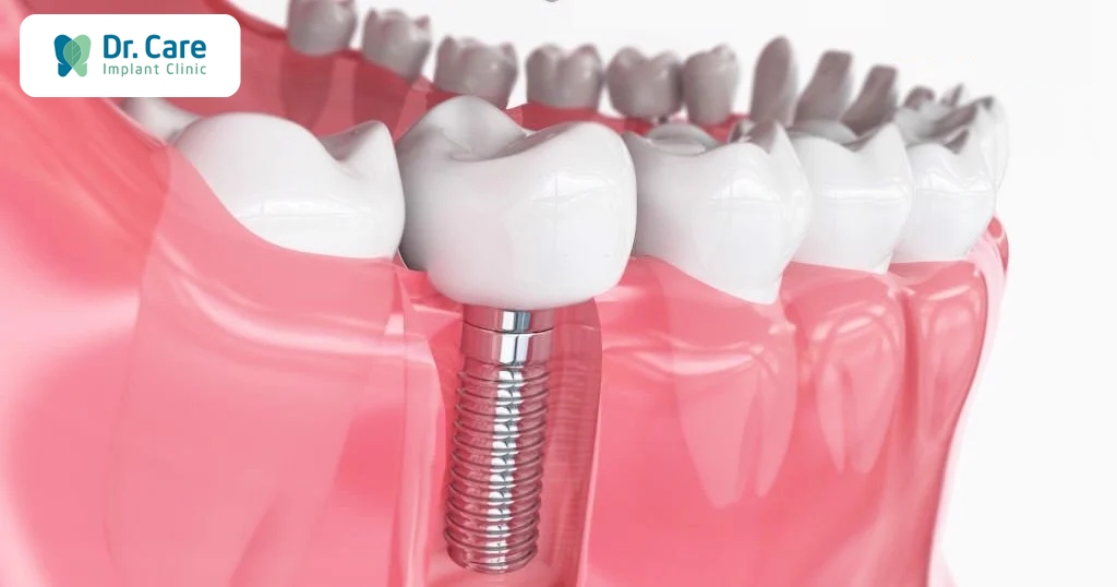 Trồng răng số 6 bằng cấy ghép Implant