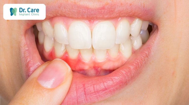 Những trường hợp nào cần phục hình răng?