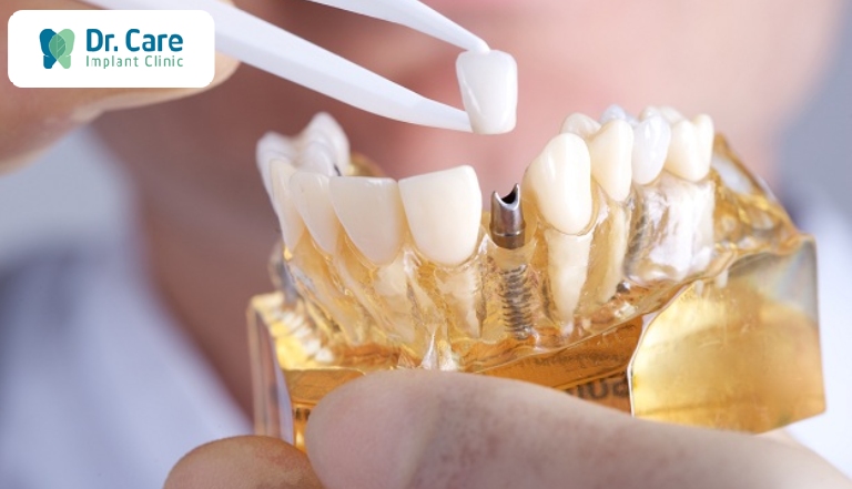 Phục hình răng cố định trên Implant 
