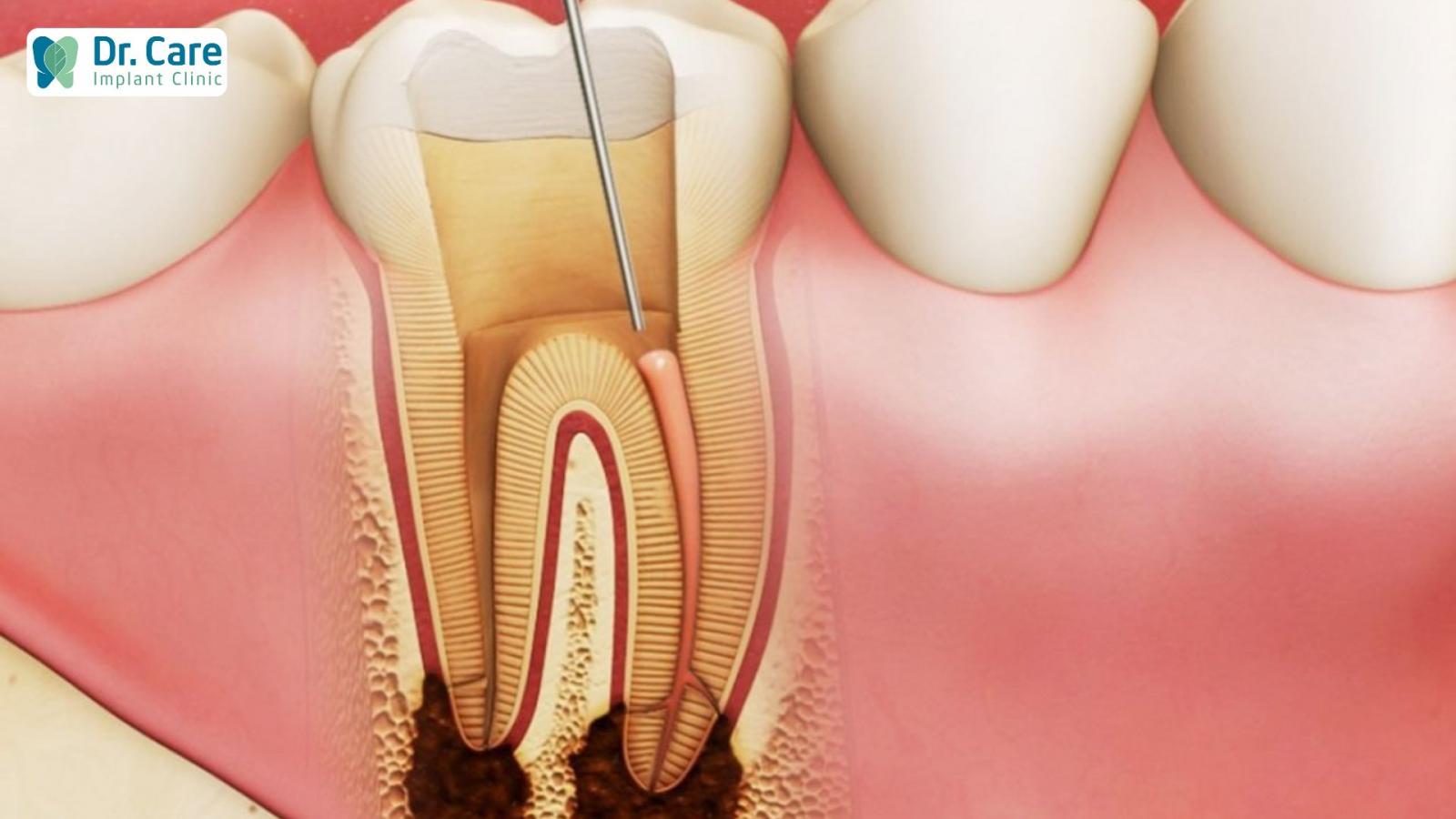 Ưu- nhược của phương pháp điều trị tủy răng 