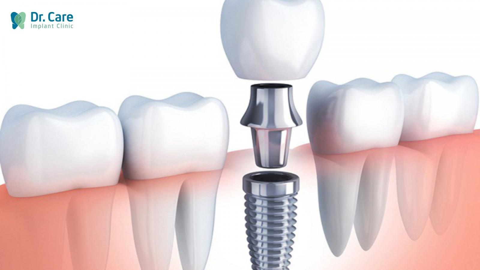Ưu- nhược điểm của trồng răng Implant