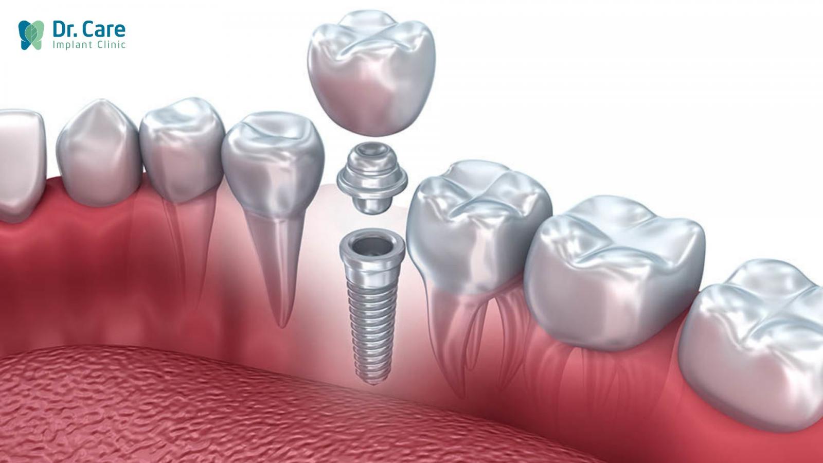 Nên điều trị tủy răng hay trồng răng Implant?