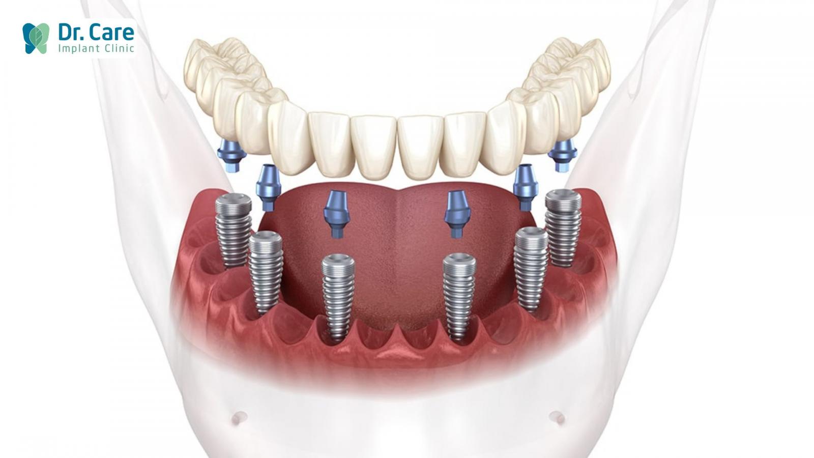 Phương pháp trồng răng Implant All On-6 là gì?