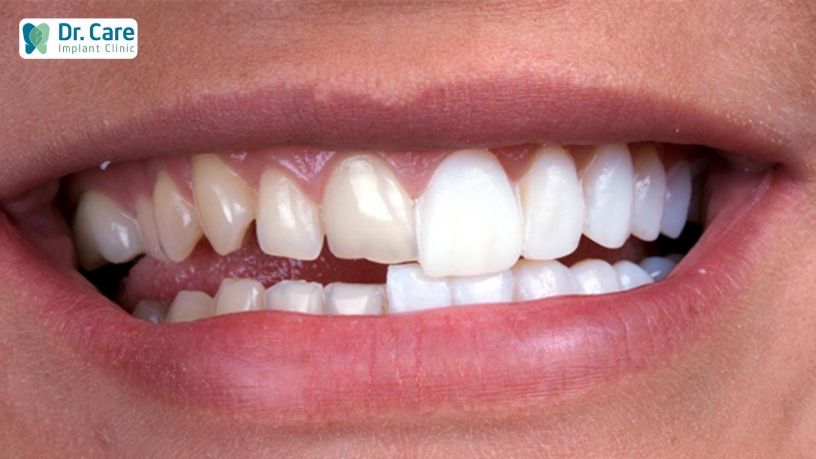 Những trường hợp nào phù hợp để dán răng sứ