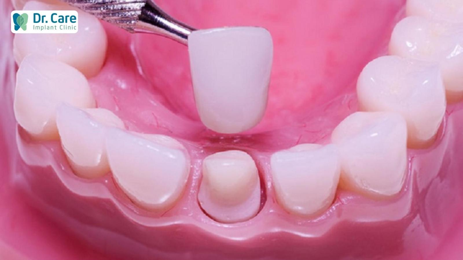 Bọc răng sứ là gì? Bọc răng sứ và dán răng sứ khác nhau như thế nào?