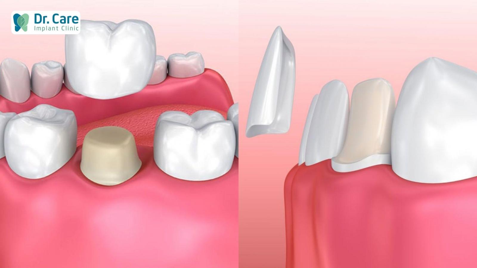 Nên dán răng sứ hay bọc răng sứ thì tốt nhất?