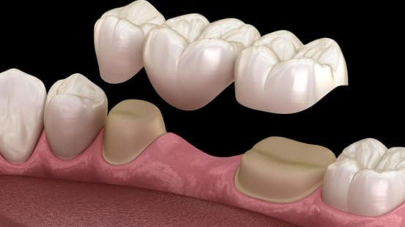 Cầu răng sứ là gì?