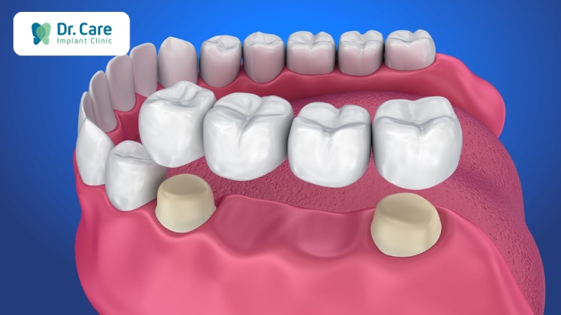 Các phương pháp phục hồi răng đã mất hiệu quả