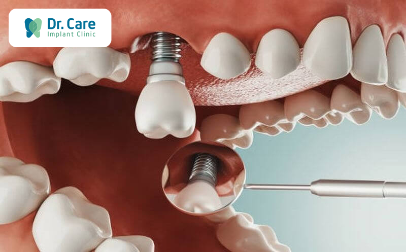 Nguyên nhân gây ra tình trạng răng lung lay sau khi cấy ghép Implant?
