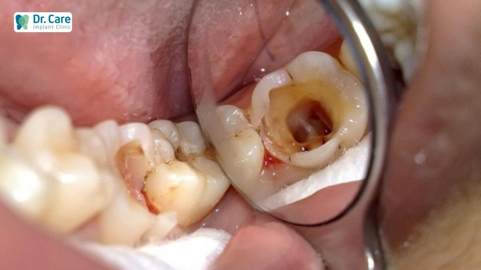 6 trường hợp không nên bọc răng sứ