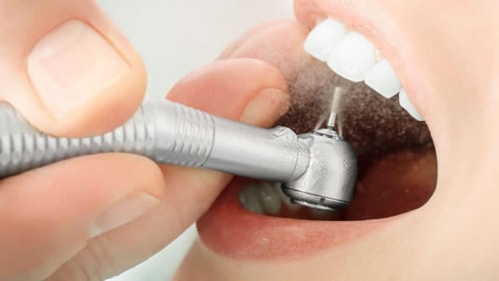 Mài răng bọc răng sứ là gì?