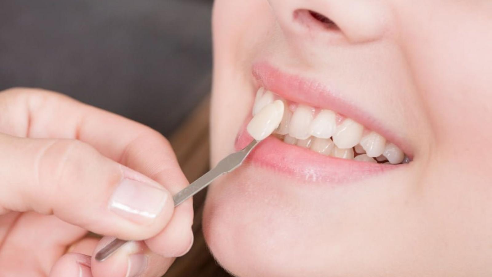3 phương pháp mài răng bọc sứ hiện nay