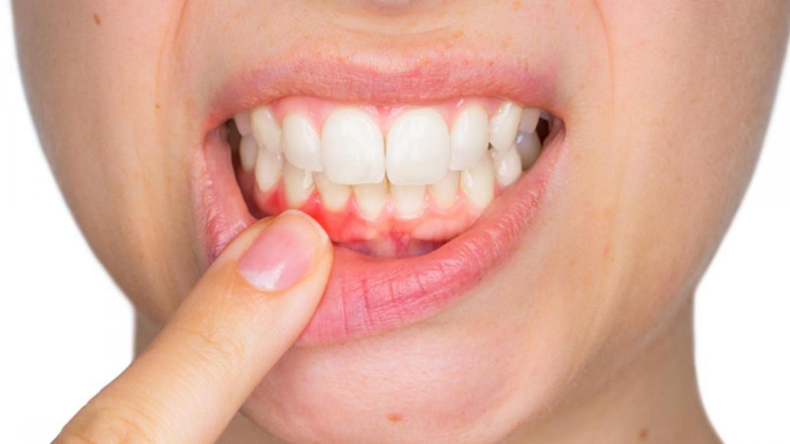 Nguyên nhân gây sưng nướu sau khi bọc răng sứ
