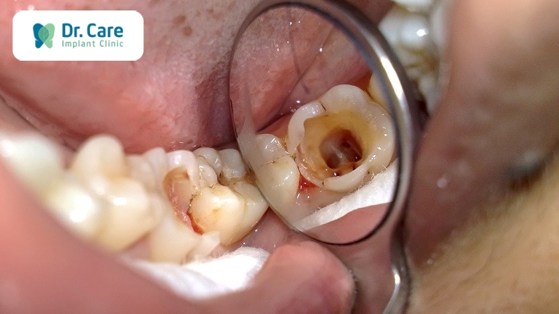 Những trường hợp răng hư bắt buộc phải nhổ răng