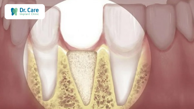Tác hại của việc hư răng - mất răng sớm do thói quen xấu 
