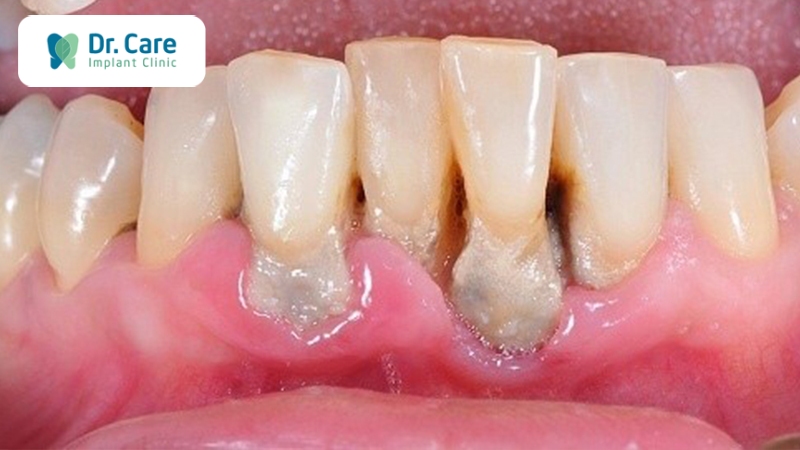 Những trường hợp răng hư bắt buộc phải nhổ răng