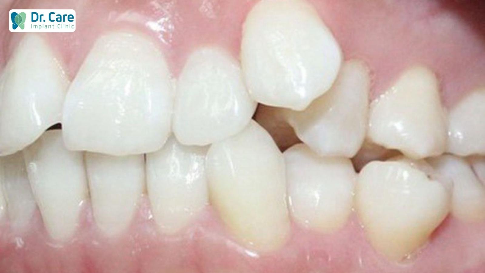 Hậu quả nghiêm trọng khi mất răng không còn chân răng