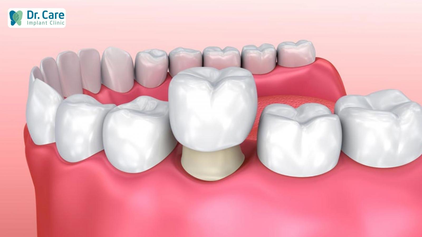 3 phương pháp trồng răng cho người không có chân răng