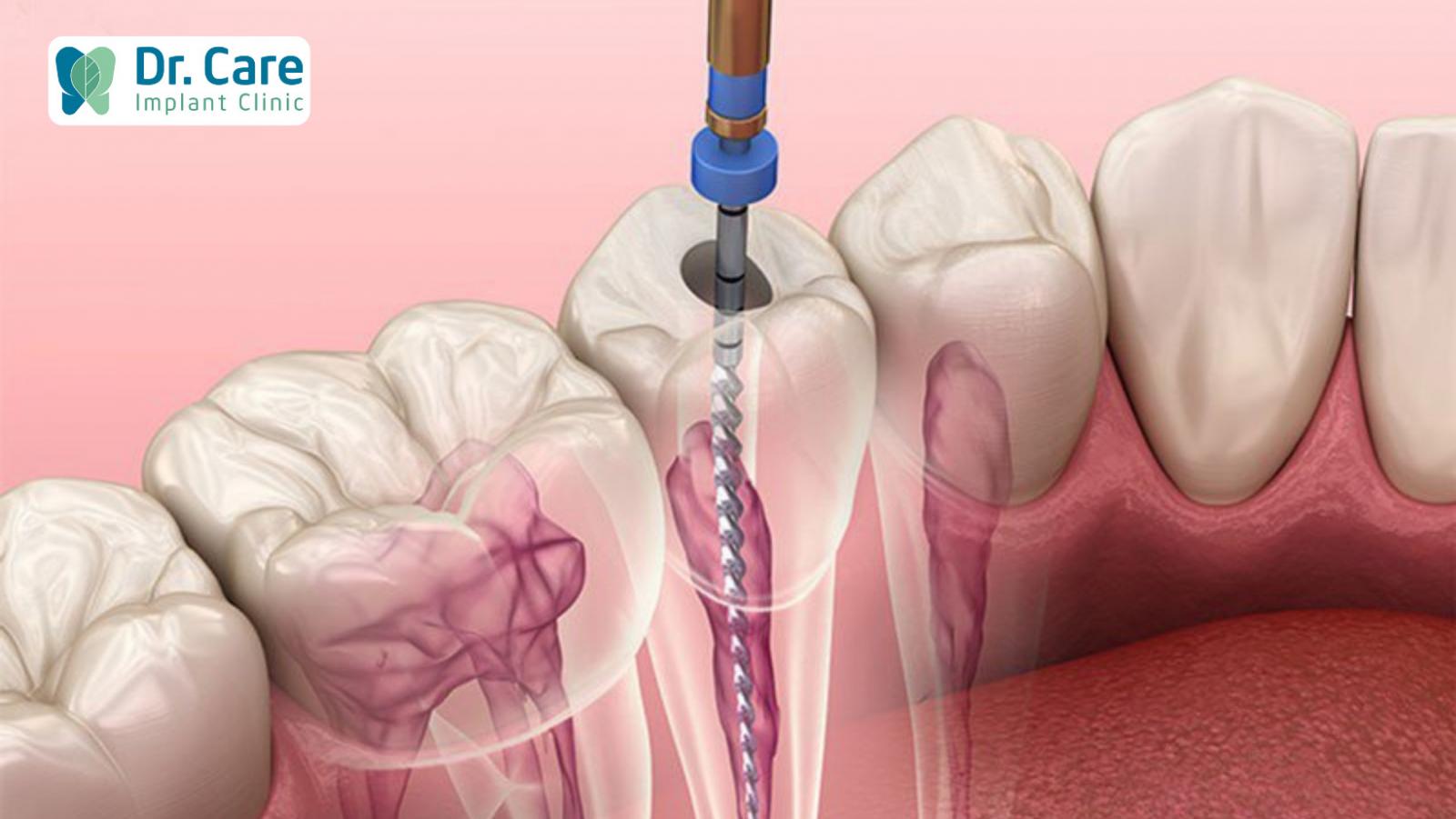 Các cách điều trị tủy răng hiệu quả