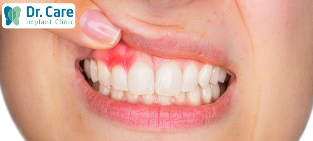 Viêm nướu răng là tình trạng gây kích ứng, sưng đỏ, chảy máu, thậm chí là mất răng