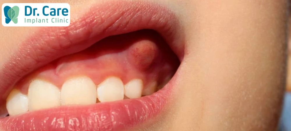Viêm nha chu là biến chứng nguy hiểm của viêm nướu răng