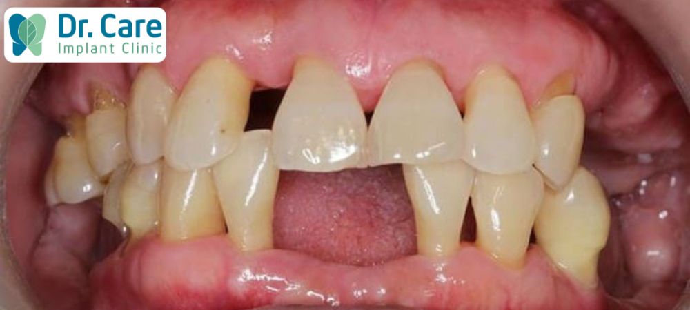  Mất răng là biến chứng nguy hiểm của bệnh viêm lợi răng