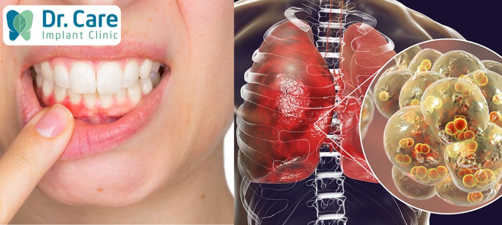 Khi bị viêm nướu răng nặng, hít vào vi khuẩn có hại sẽ gây ảnh hưởng đến phổi