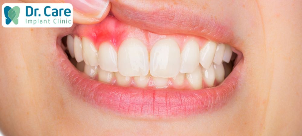 Viêm nướu răng không phải là bệnh lý nguy hiểm 