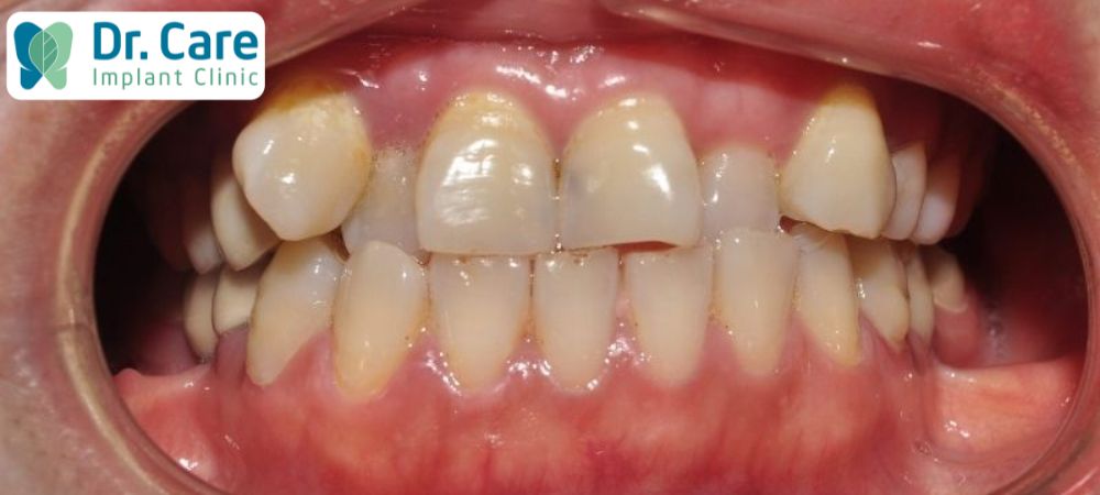 Răng khấp khểnh là yếu tố gây nên tình trạng viêm nướu răng nặng