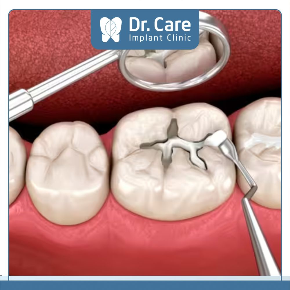 Trám răng là kỹ thuật Nha khoa thường sử dụng để khắc phục tình trạng sâu răng, răng thưa, mẻ