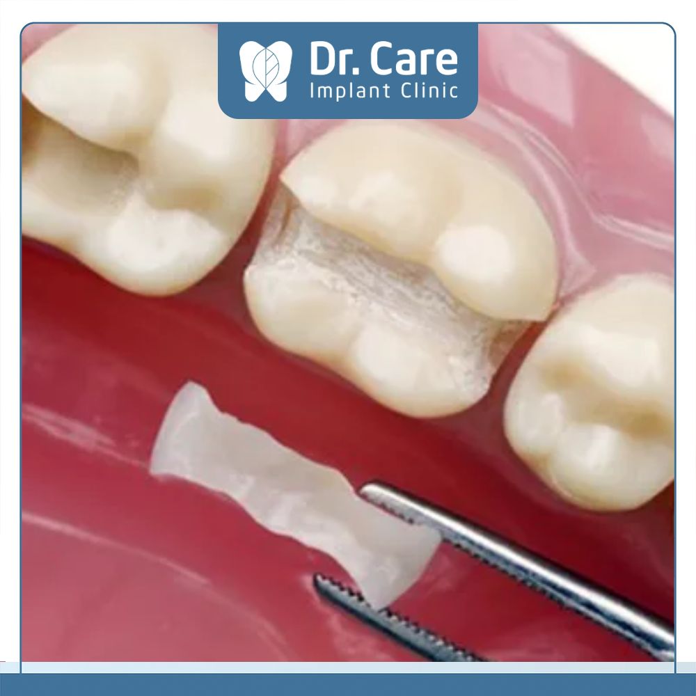 Trám răng bằng sứ là kỹ thuật sử dụng vật liệu trám sứ (inlay, onlay) với công nghệ CAD/ CAM 