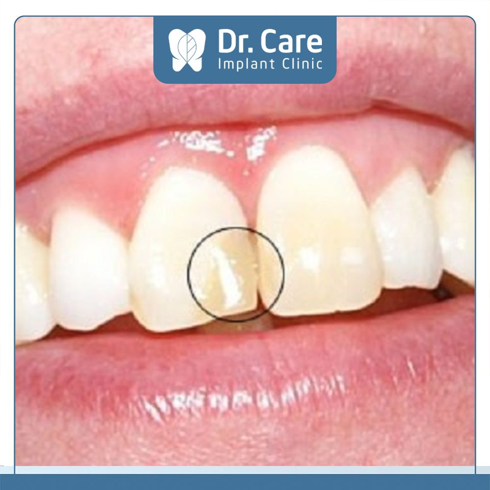 Trám răng cho trường hợp răng bị thưa là phương án phù hợp để giúp đóng kín các kẽ răng thưa, mang lại nụ cười tự nhiên
