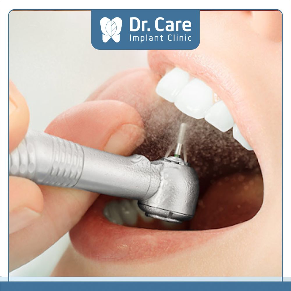 Trước khi trám răng, bác sĩ cần loại bỏ vùng răng sâu và mài một phần men răng nhằm tăng độ bám dính của vật liệu trám