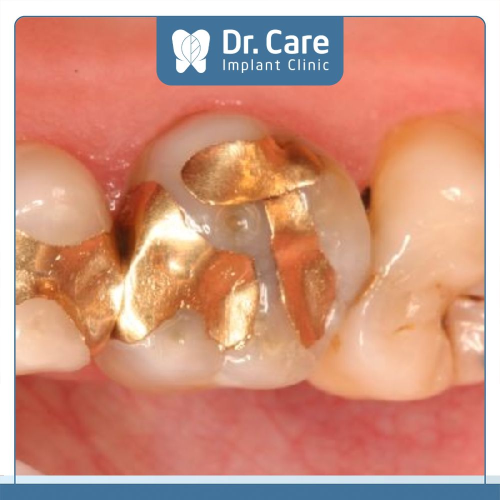 Trám răng bằng vàng là phương pháp Nha khoa sử dụng vàng để lấp đầy phần mô răng bị tổn thương do sâu răng, sứt mẻ, vỡ