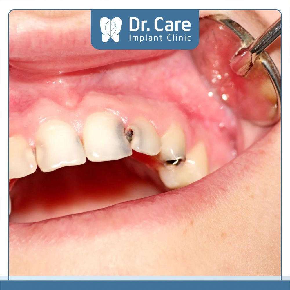 Sâu răng có lỗ hổng vì vi khuẩn tấn công men răng nên cần trám răng