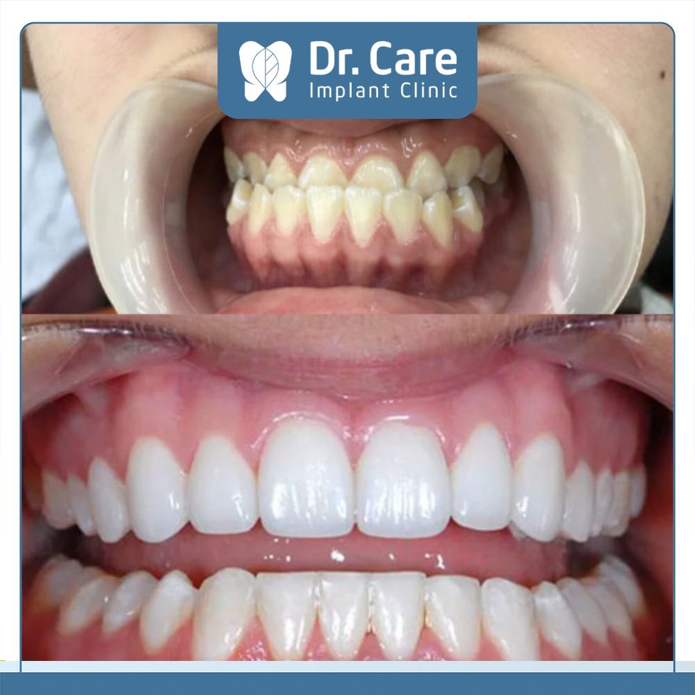 Răng móm là thuật ngữ nha khoa nói đến dạng sai lệch khớp cắn giữa 2 hàm, cụ thể là khớp cắn ngược