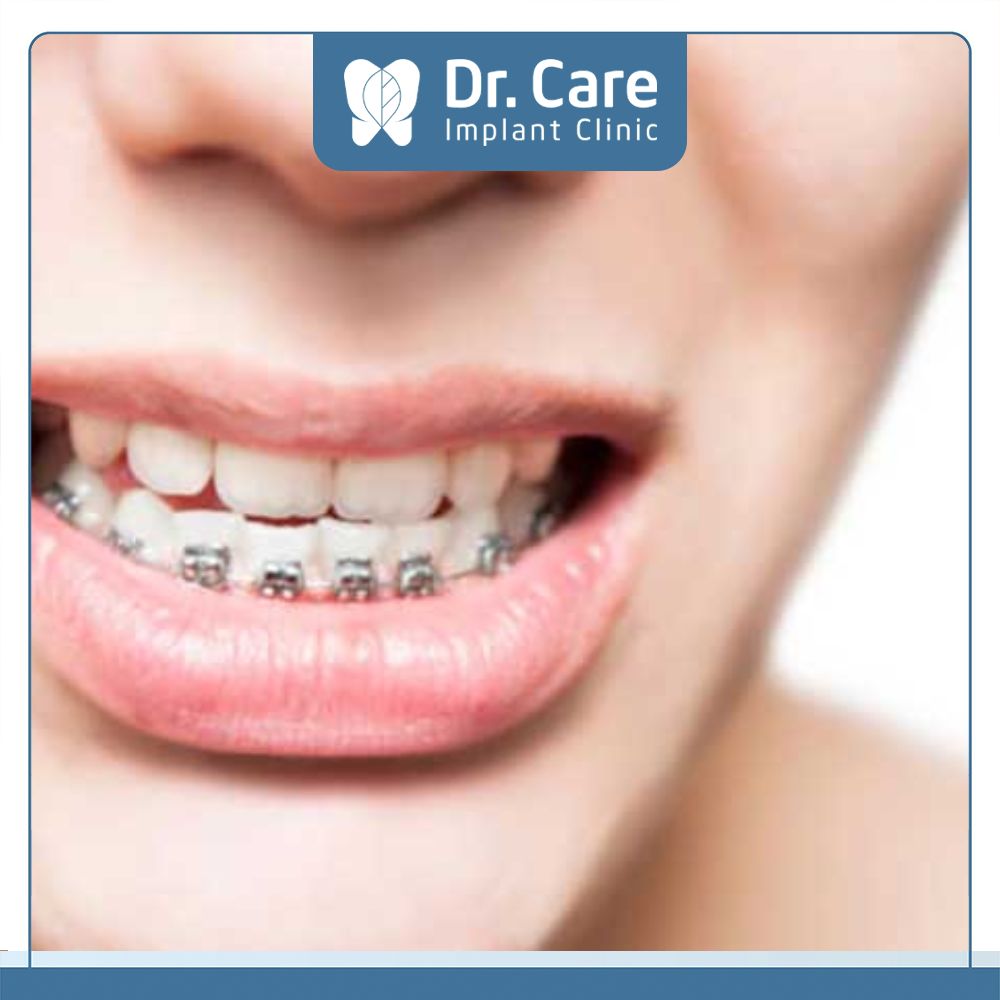 Phương pháp chữa răng móm do răng thì có thể lựa chọn niềng răng để chỉnh toàn bộ hàm răng về đúng vị trí và khớp cắn chuẩn