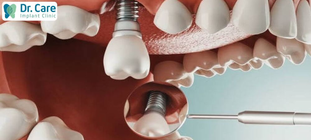 Trồng răng Implant là giải pháp tối ưu để phục hồi răng bị mất, khôi phục chức năng ăn nhai lẫn thẩm mỹ cho Cô Chú, Anh Chị