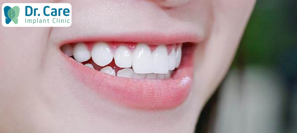 Răng sứ Lava có ưu điểm nổi bật là mang lại độ thẩm mỹ cao, đảm bảo màu sắc và ánh sáng như răng tự nhiên