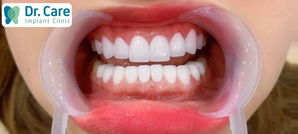 Lựa chọn màu răng sứ Lava trước khi trồng răng để tăng độ phù hợp với gương mặt, làn da, làm nụ cười tự tin hơn