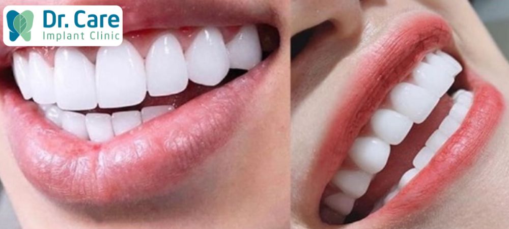 Giá răng sứ Lava dao động khoảng từ 6.000.000 - 7.000.000 VNĐ/răng