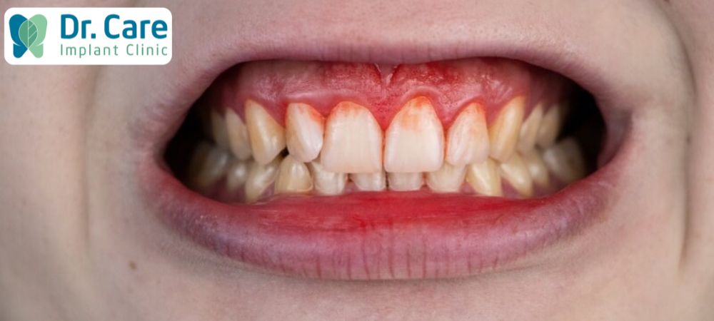 Chảy máu chân răng là một trong dấu hiệu của bệnh lý răng miệng thường gặp, chảy máu từ nướu, hốc răng