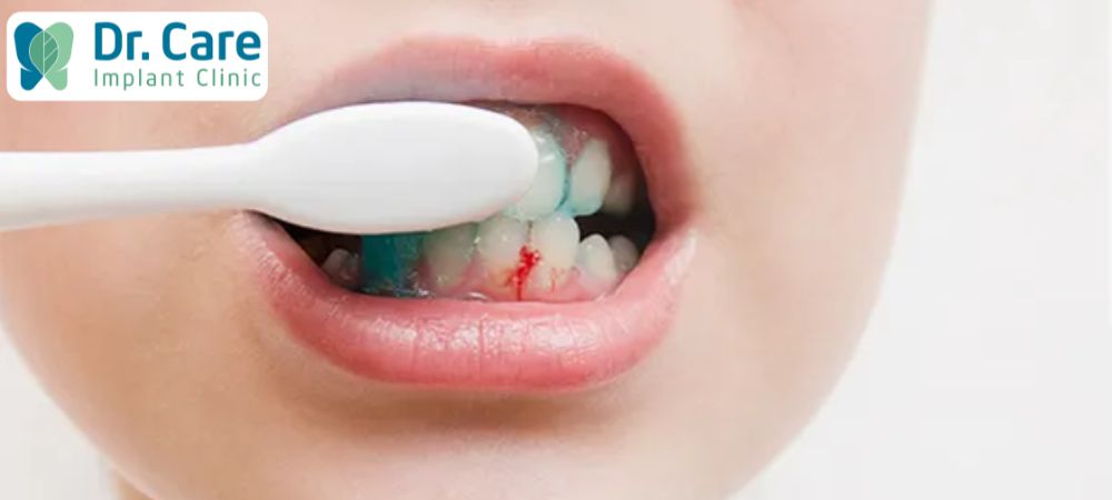 Khi chảy máu răng miệng cần lưu ý về chế độ vệ sinh răng miệng