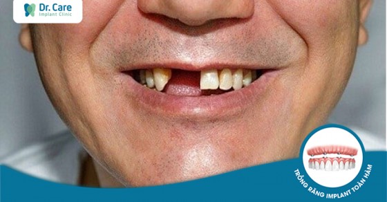 Tôi bị mất răng cửa, có trồng được Implant không?